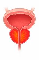 Infiammazione della prostata